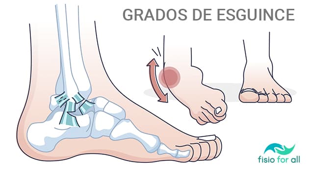 Tratamiento de esguince de tobillo en Clínica de fisioterapia en Madrid fisio for all