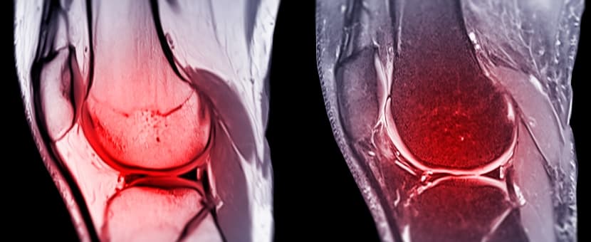 Ligamento cruzado anterior - Rehabilitación de lesiones en Madrid