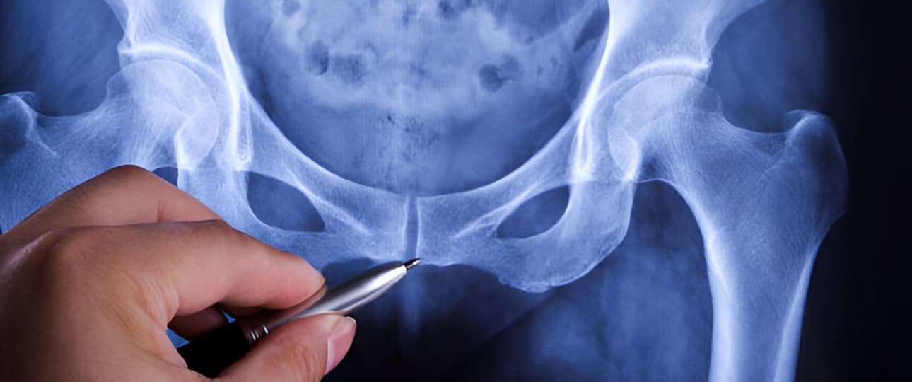 Pacientes prostatectomizados - Suelo pélvico hombres